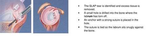 slap labrum tear test|slap tear surgery recovery time.